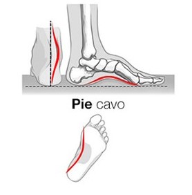 zapatos respetuosos pies cavos opiniones